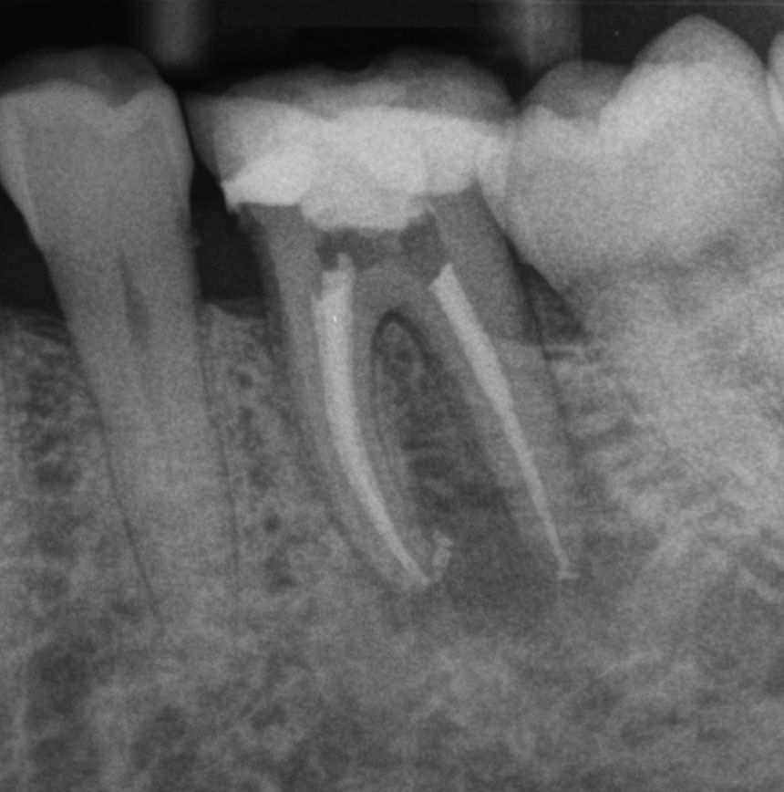 Image de chirurgie endodontique à morges