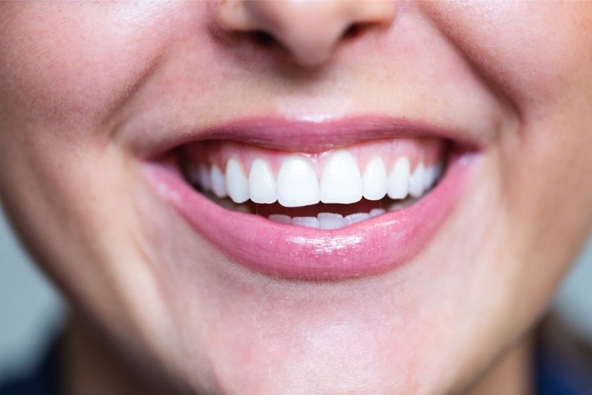 Image d'un sourire blanchit clinique dentaire du lac morges